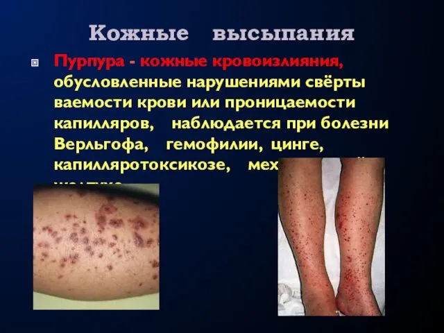 Кожные высыпания Пурпура - кожные кровоизлияния, обусловленные нарушениями свёрты­ваемости крови