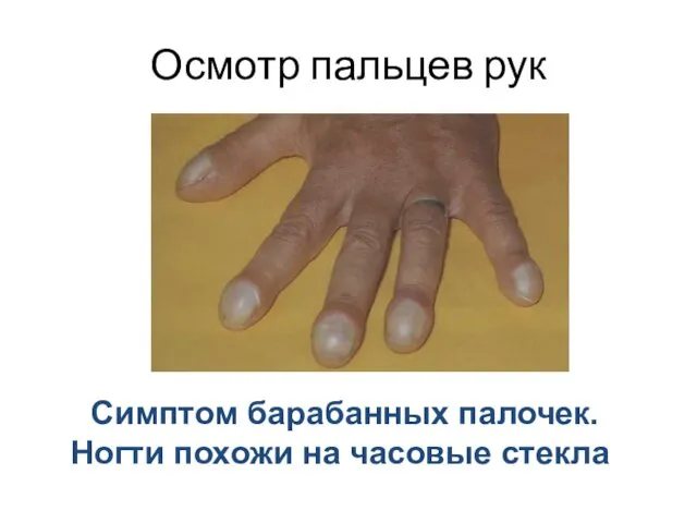 Осмотр пальцев рук Симптом барабанных палочек. Ногти похожи на часовые стекла