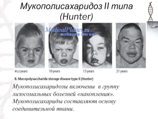 Мукополисахаридоз II типа (Hunter) Мукополисахаридозы включены в группу лизосомальных болезней «накопления». Мукополисахариды составляют основу соединительной ткани.