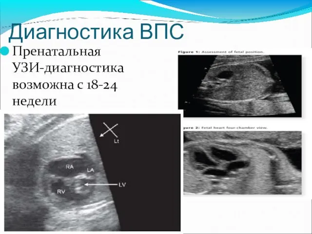 Диагностика ВПС Пренатальная УЗИ-диагностика возможна с 18-24 недели