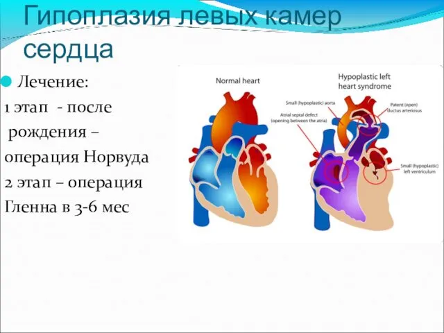 Гипоплазия левых камер сердца Лечение: 1 этап - после рождения