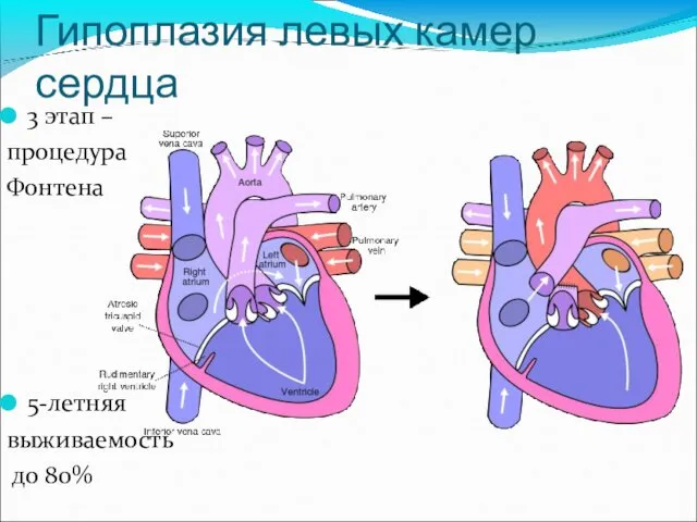 Гипоплазия левых камер сердца 3 этап – процедура Фонтена 5-летняя выживаемость до 80%