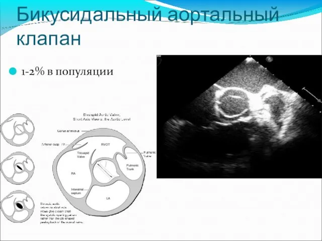 Бикусидальный аортальный клапан 1-2% в популяции