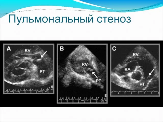 Пульмональный стеноз