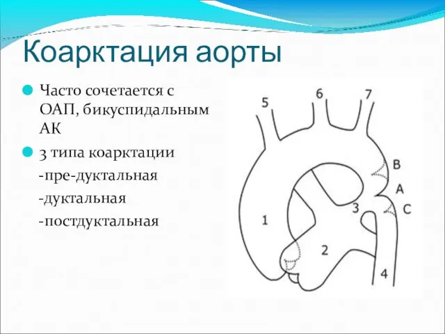 Коарктация аорты Часто сочетается с ОАП, бикуспидальным АК 3 типа коарктации -пре-дуктальная -дуктальная -постдуктальная