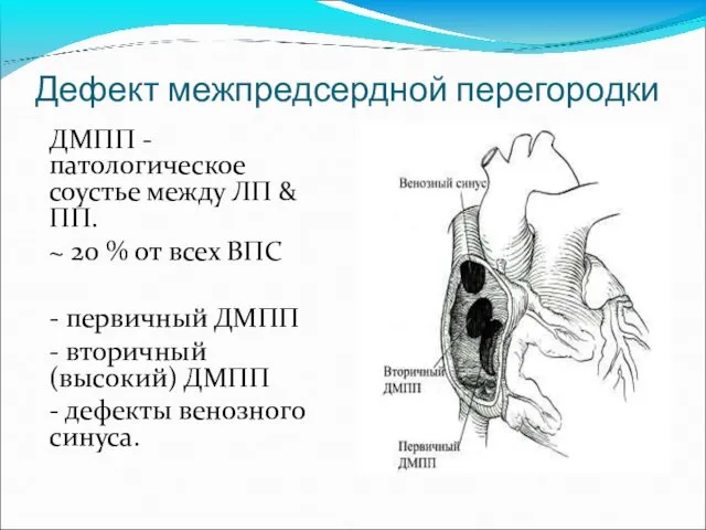 Дефект межпредсердной перегородки ДМПП - патологическое соустье между ЛП &