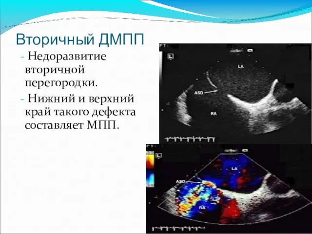 Вторичный ДМПП Недоразвитие вторичной перегородки. Нижний и верхний край такого дефекта составляет МПП.