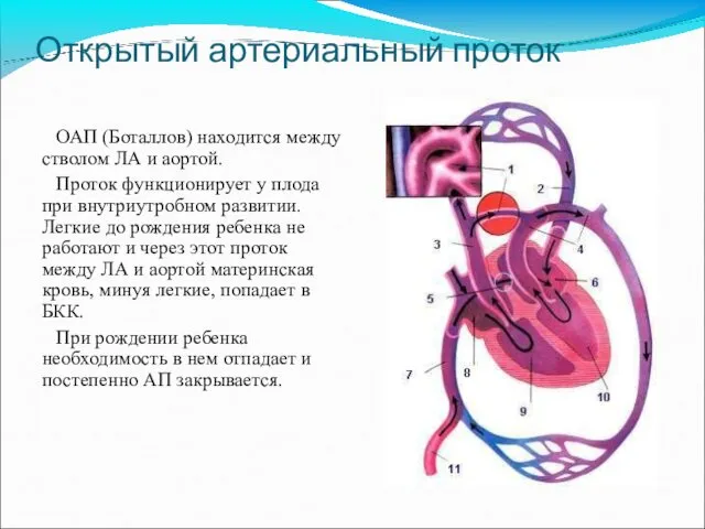 Открытый артериальный проток ОАП (Боталлов) находится между стволом ЛА и