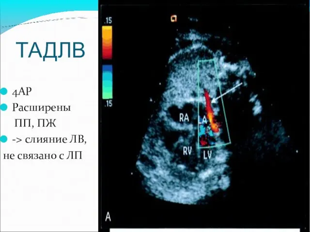 ТАДЛВ 4AP Расширены ПП, ПЖ -> слияние ЛВ, не связано с ЛП