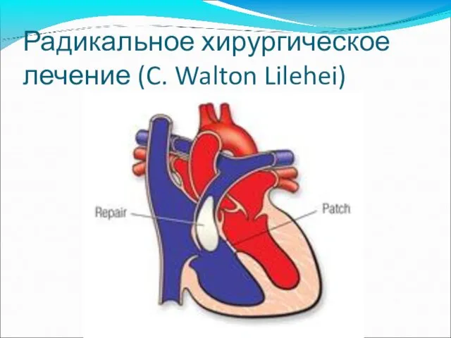 Радикальное хирургическое лечение (C. Walton Lilehei)