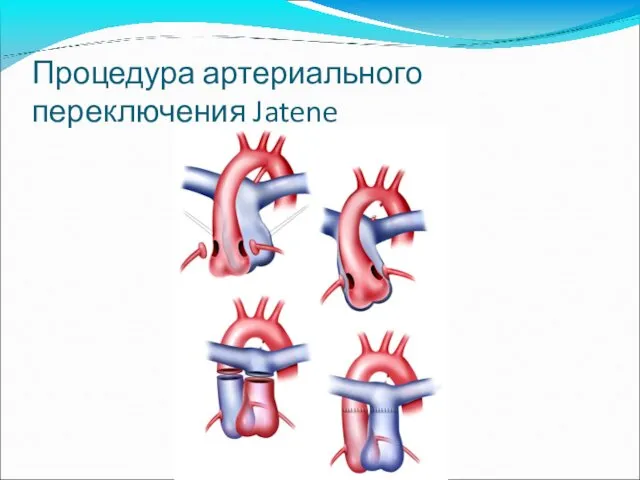 Процедура артериального переключения Jatene