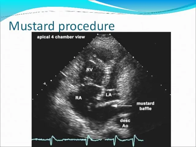 Mustard procedure