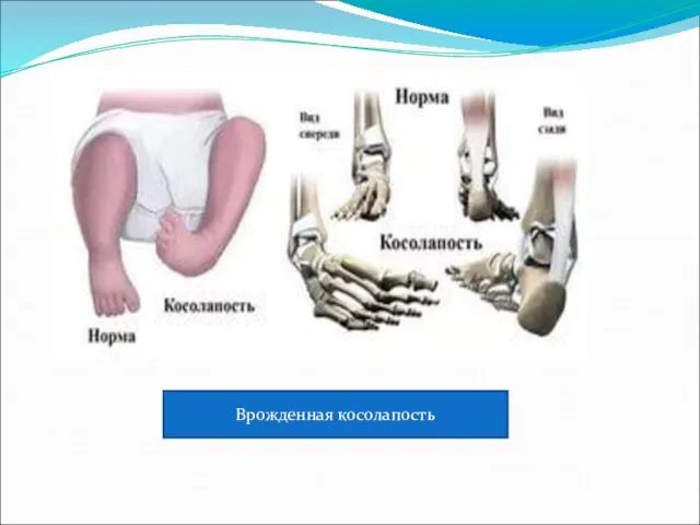 Врожденная косолапость