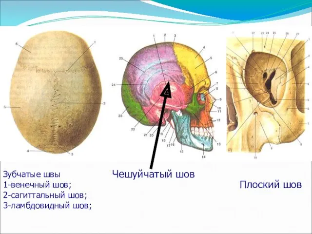 Зубчатые швы 1-венечный шов; 2-сагиттальный шов; 3-ламбдовидный шов; Чешуйчатый шов Плоский шов