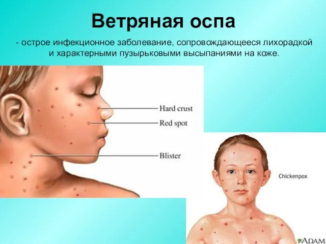 Ветряная оспа - острое инфекционное заболевание, сопровождающееся лихорадкой и характерными пузырьковыми высыпаниями на коже.