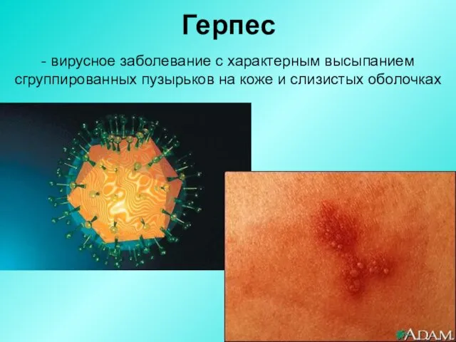 Герпес - вирусное заболевание с характерным высыпанием сгруппированных пузырьков на коже и слизистых оболочках