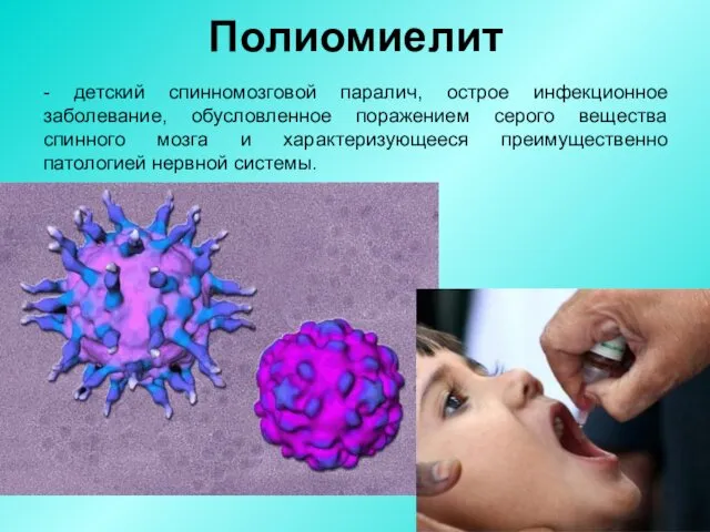 Полиомиелит - детский спинномозговой паралич, острое инфекционное заболевание, обусловленное поражением серого вещества спинного