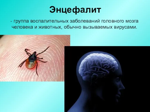 Энцефалит - группа воспалительных заболеваний головного мозга человека и животных, обычно вызываемых вирусами.