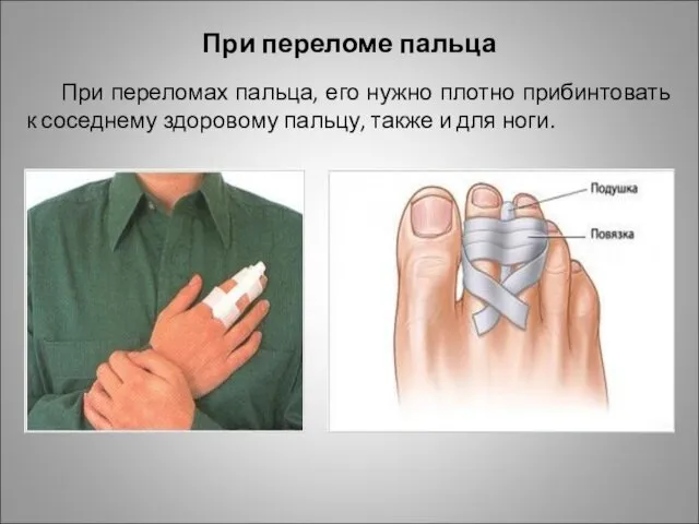 При переломе пальца При переломах пальца, его нужно плотно прибинтовать