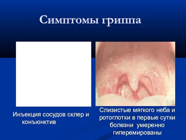 Симптомы гриппа Инъекция сосудов склер и конъюнктив Слизистые мягкого неба