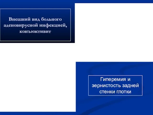 Внешний вид больного аденовирусной инфекцией, конъюктивит Гиперемия и зернистость задней стенки глотки