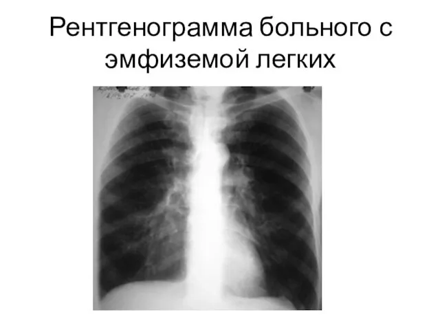 Рентгенограмма больного с эмфиземой легких