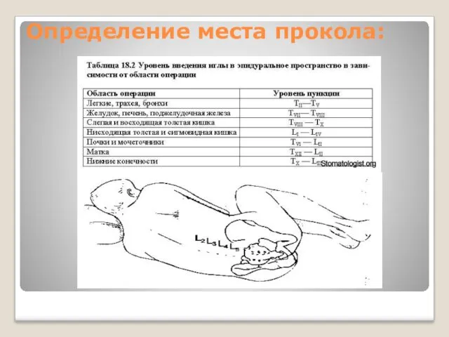 Определение места прокола: