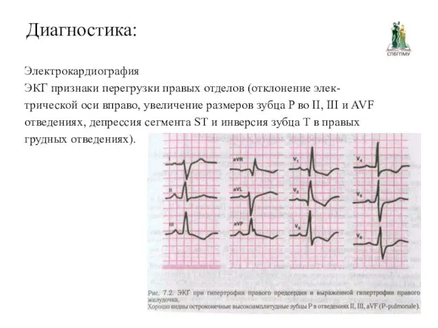 Диагностика: Электрокардиография ЭКГ признаки перегрузки правых отделов (отклонение элек- трической