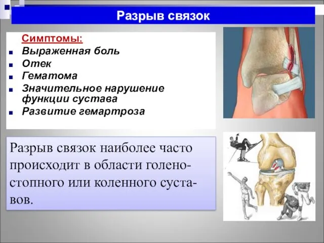 Разрыв связок Симптомы: Выраженная боль Отек Гематома Значительное нарушение функции сустава Развитие гемартроза