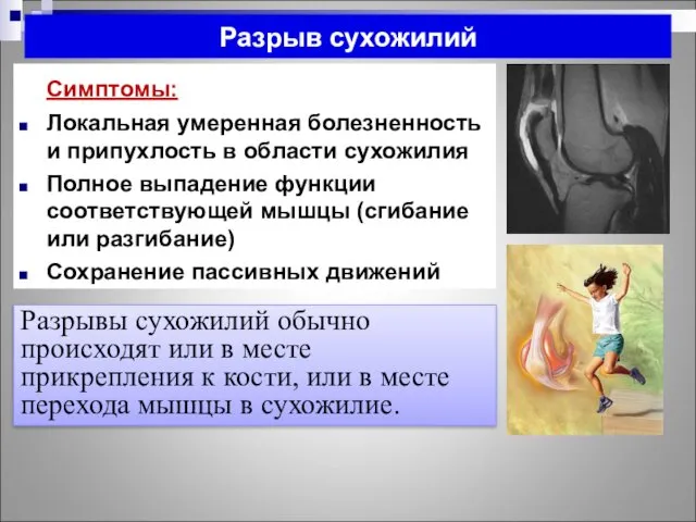 Разрыв сухожилий Симптомы: Локальная умеренная болезненность и припухлость в области сухожилия Полное выпадение