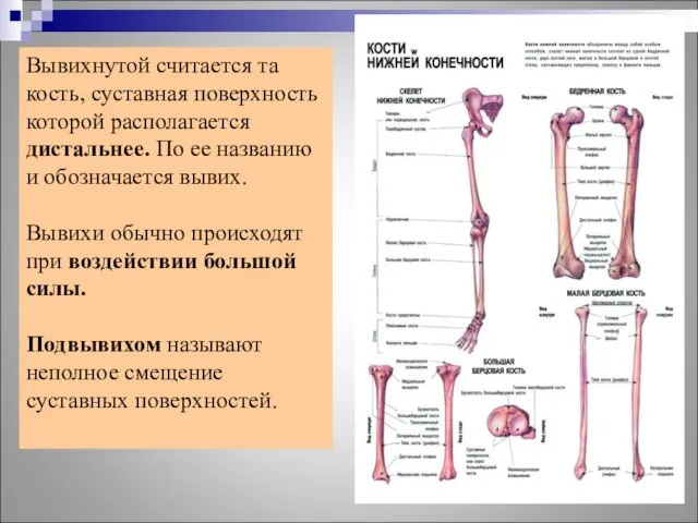 Вывихнутой считается та кость, суставная поверхность которой располагается дистальнее. По