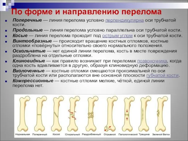 По форме и направлению перелома Поперечные — линия перелома условно перпендикулярна оси трубчатой