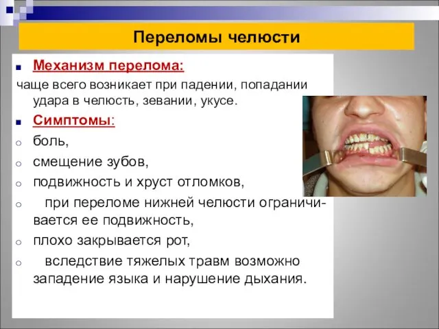 Переломы челюсти Механизм перелома: чаще всего возникает при падении, попадании