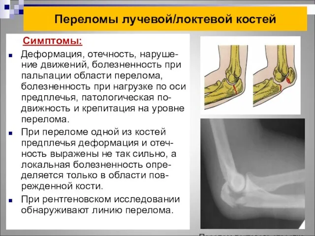 Переломы лучевой/локтевой костей Симптомы: Деформация, отечность, наруше-ние движений, болезненность при пальпации области перелома,