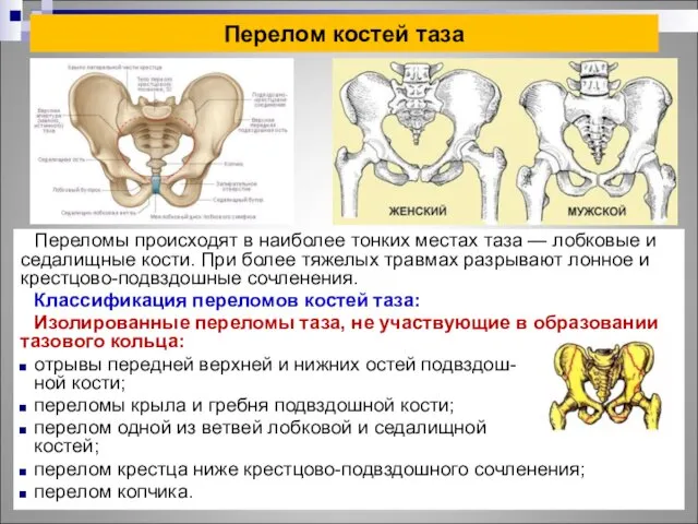 Перелом костей таза Переломы происходят в наиболее тонких местах таза — лобковые и