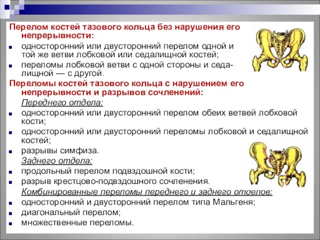 Перелом костей тазового кольца без нарушения его непрерывности: односторонний или двусторонний перелом одной