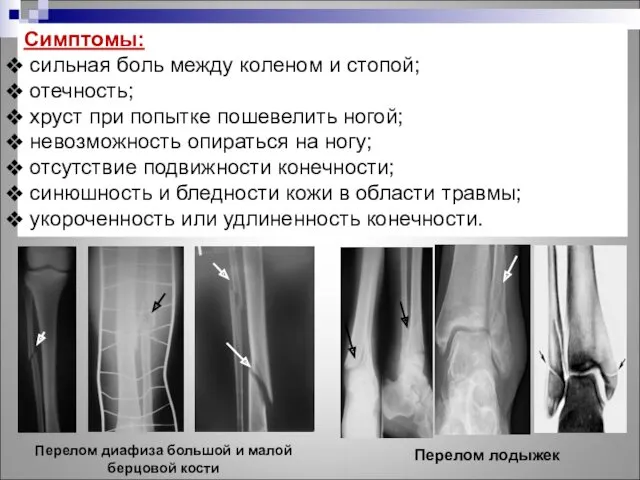 Симптомы: сильная боль между коленом и стопой; отечность; хруст при попытке пошевелить ногой;