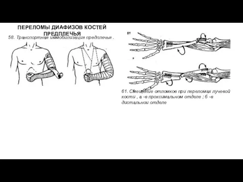 ПЕРЕЛОМЫ ДИАФИЗОВ КОСТЕЙ ПРЕДПЛЕЧЬЯ 58. Транспортная иммобилизация предплечья . 61.