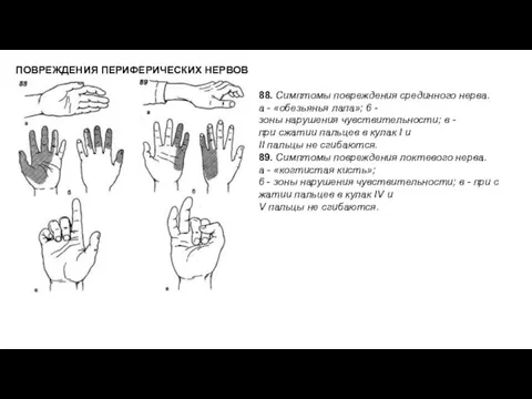 ПОВРЕЖДЕНИЯ ПЕРИФЕРИЧЕСКИХ НЕРВОВ 88. Симптомы повреждения срединного нерва. а -