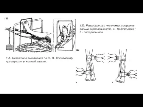 125. Скелетное вытяжение по В . В . Ключевскому при