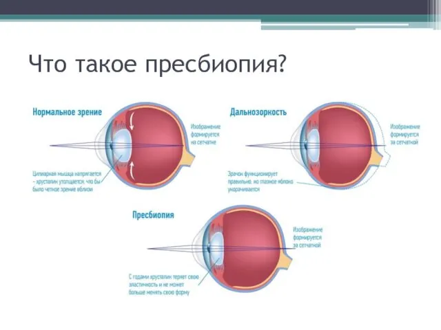 Что такое пресбиопия?