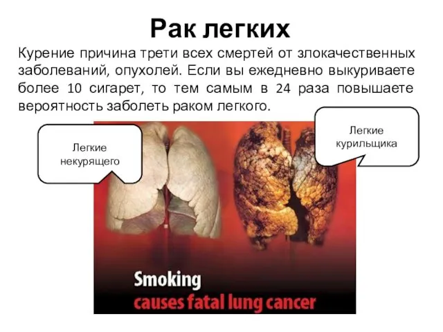 Рак легких Курение причина трети всех смертей от злокачественных заболеваний, опухолей. Если вы