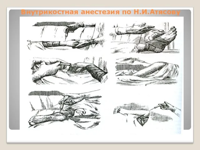 Внутрикостная анестезия по Н.И.Атясову