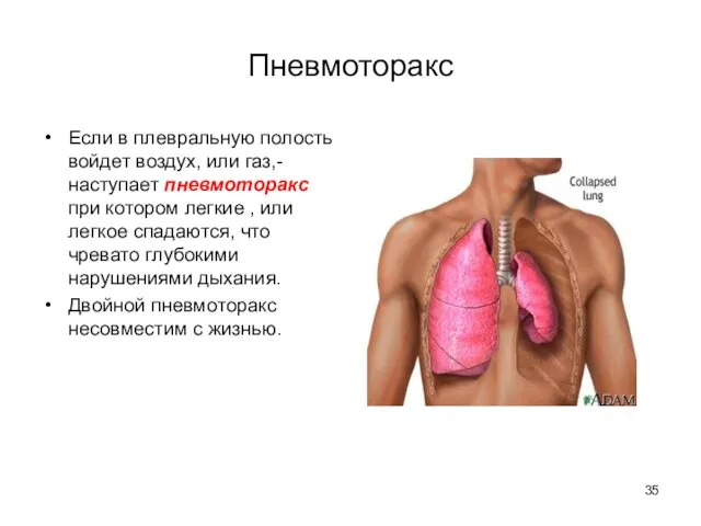 Пневмоторакс Если в плевральную полость войдет воздух, или газ,- наступает