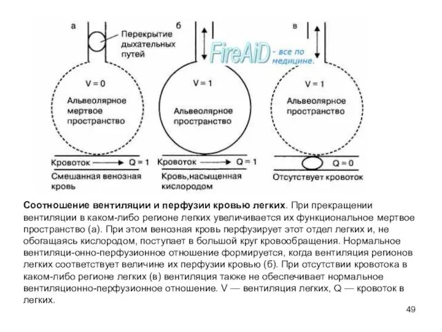 Соотношение вентиляции и перфузии кровью легких. При прекращении вентиляции в