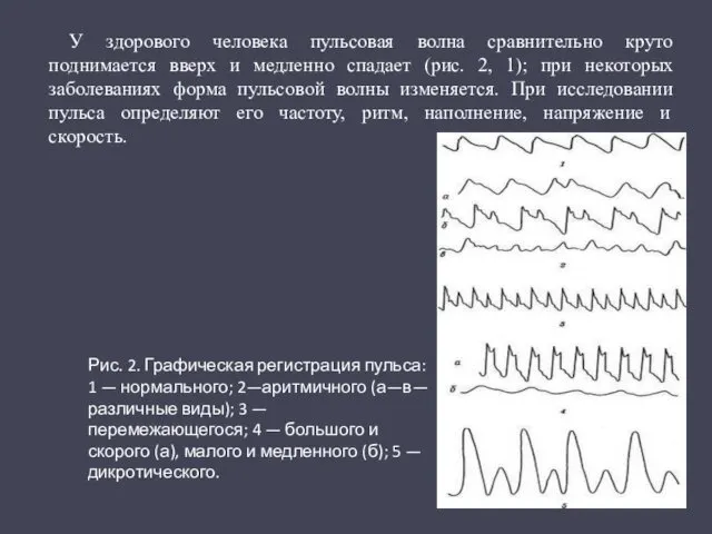 У здорового человека пульсовая волна сравнительно круто поднимается вверх и