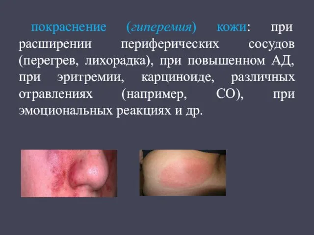 покраснение (гиперемия) кожи: при расширении периферических сосудов (перегрев, лихорадка), при