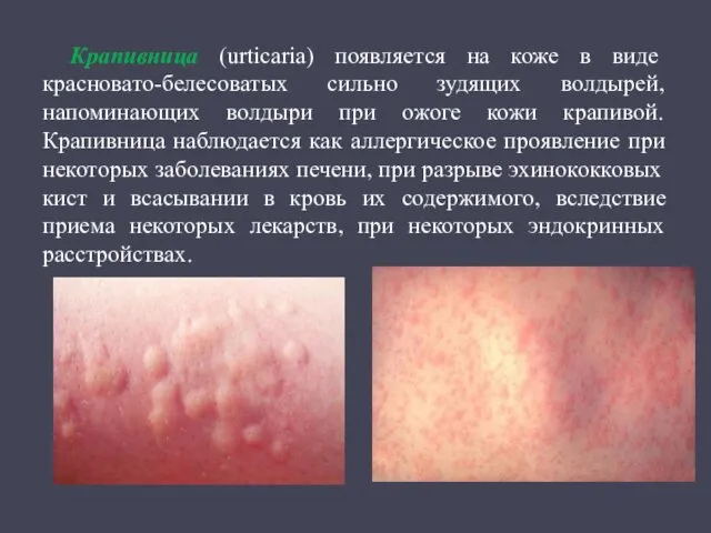 Крапивница (urticaria) появляется на коже в виде красновато-белесоватых сильно зудящих