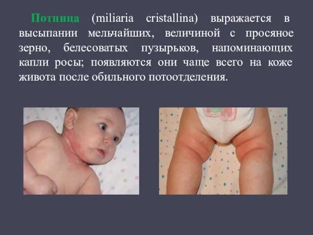 Потница (miliaria cristallina) выражается в высыпании мельчайших, величиной с просяное