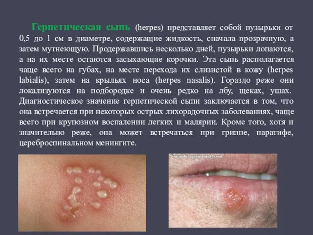 Герпетическая сыпь (herpes) представляет собой пузырьки от 0,5 до 1